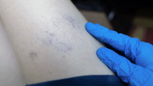 סקלרותרפיה מחיר