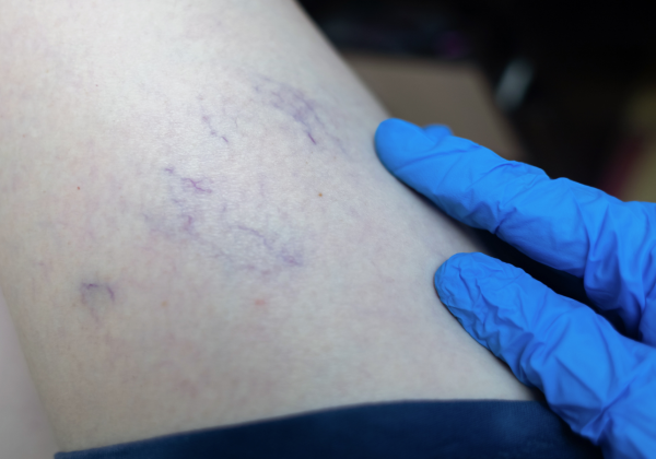 סקלרותרפיה מחיר לטיפולי העלמת נימים וורידים